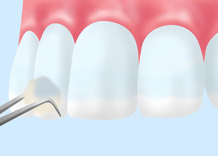 天然歯へのフッ素塗布